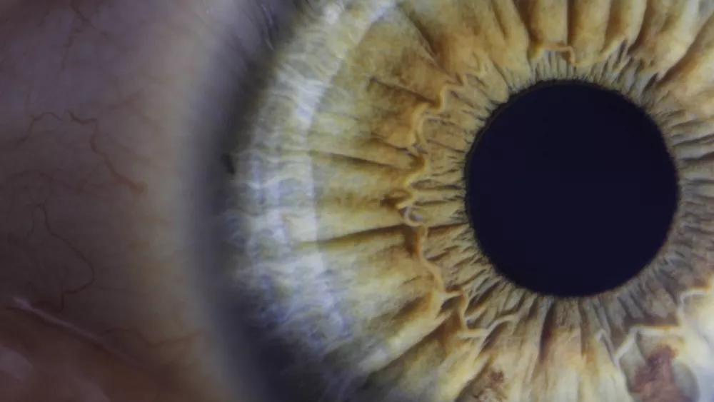 Glaucoma: El ladrón silencioso de tu mirada.